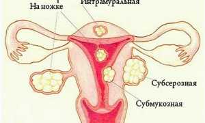 Симптомы миомы матки и лечение народными средствами
