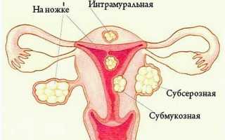 Симптомы миомы матки и лечение народными средствами