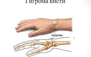 Лечение гигромы в домашних условиях