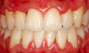 Хронический гингивит: особенности течения, методы лечения