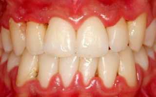 Хронический гингивит: особенности течения, методы лечения