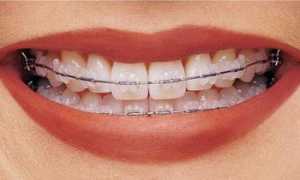 Как выполняется активация брекетов и зачем нужна их подтяжка? Всё о ношении конструкции и уходу за ней