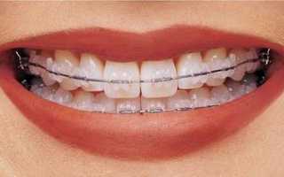 Как выполняется активация брекетов и зачем нужна их подтяжка? Всё о ношении конструкции и уходу за ней