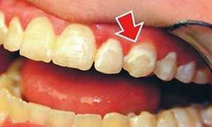 Важно вовремя предотвратить развитие патологии в полости рта! Методы лечения кариеса зубов