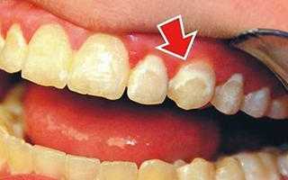 Важно вовремя предотвратить развитие патологии в полости рта! Методы лечения кариеса зубов