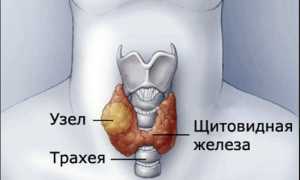 Аденома щитовидной железы: симптомы и лечение