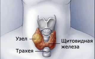 Аденома щитовидной железы: симптомы и лечение