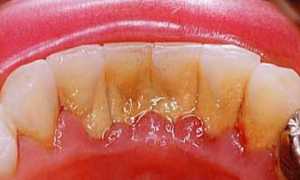 Причины возникновения гингивита