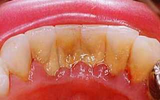 Причины возникновения гингивита