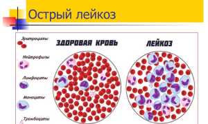 Симптоматика лимфобластной бластомы