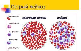 Симптоматика лимфобластной бластомы