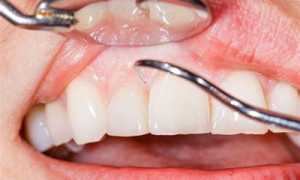 4 простых способа профилактики пародонтоза, которые должен знать каждый