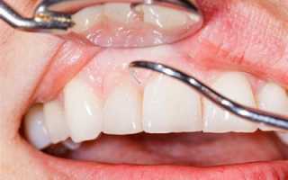 4 простых способа профилактики пародонтоза, которые должен знать каждый