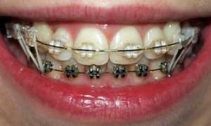 Что быстрее выровняет улыбку? Виды брекет-систем