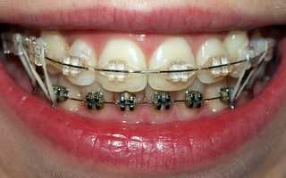 Что быстрее выровняет улыбку? Виды брекет-систем