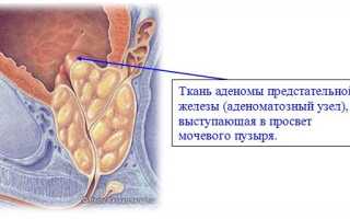Рост аденомы предстательной железы