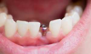 Моментальное протезирование: все, что нужно знать об одноэтапной имплантации зубов