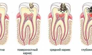 Средний кариес