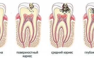 Средний кариес