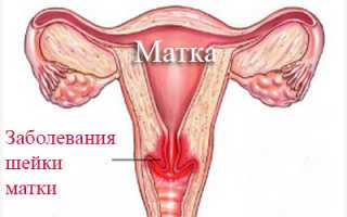 Карцинома in situ: лечение и период восстановления