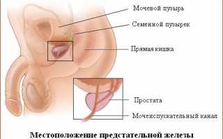 Карцинома простаты: симптомы, лечение, прогнозы