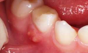 От его симптомов не спрятаться! Периодонтит: что это такое?