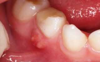 От его симптомов не спрятаться! Периодонтит: что это такое?