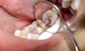 Гнойный пульпит: симптоматика и особенности лечения