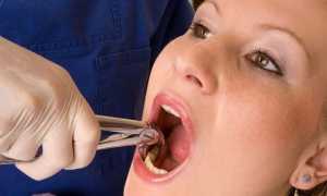 Удаление зуба при периодонтите. Срочное и плановое удаление зуба.