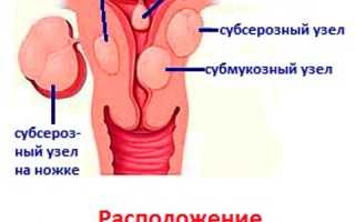 Лечение фиброматозных узлов