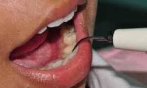 Удаление зубного камня