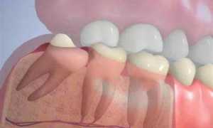 Осложнения можно избежать! Удаление зуба мудрости: что делать после операции?