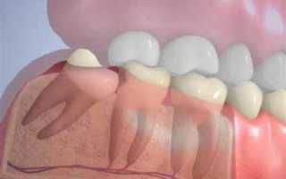 Осложнения можно избежать! Удаление зуба мудрости: что делать после операции?