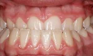 Мезиальный прикус: как обнаружить и вылечить?