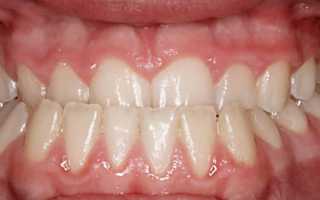 Мезиальный прикус: как обнаружить и вылечить?