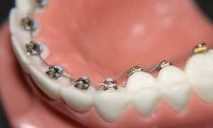 Невидимые брекеты: виды и их особенности