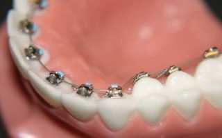 Невидимые брекеты: виды и их особенности