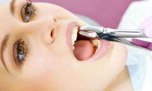 Это должен знать каждый! Удаление зуба из десны: этапы и техники операции, описание процедуры