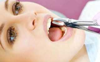 Это должен знать каждый! Удаление зуба из десны: этапы и техники операции, описание процедуры