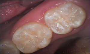 Причины кариеса