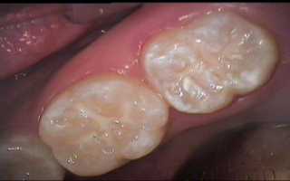 Причины кариеса