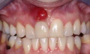 Как разобраться в формах периодонтита: классификация поможет в лечении болезни?