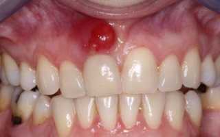 Как разобраться в формах периодонтита: классификация поможет в лечении болезни?