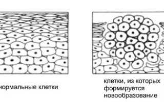 Болезнь лимфома: признаки, симптомы и лечение
