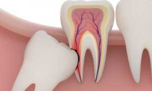 Что нужно знать перед операцией: опасно ли сложное удаление зуба мудрости?