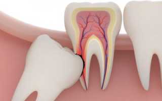 Что нужно знать перед операцией: опасно ли сложное удаление зуба мудрости?