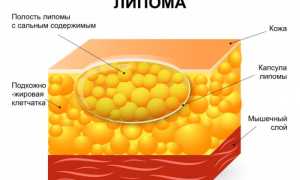 Липома – это просто жировик?