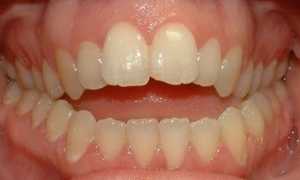 Он приносит столько неудобств! Что такое неправильный прикус?