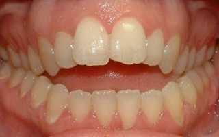 Он приносит столько неудобств! Что такое неправильный прикус?