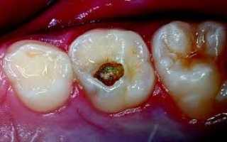 Глубокий кариес: причины, диагностика, лечение, профилактика